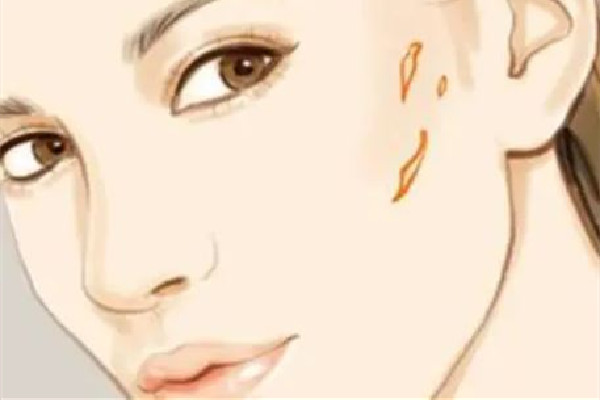 中南路正璞醫(yī)療美容·痘坑疤痕&皮膚微整店祛疤效果怎么樣 祛疤會(huì)越來越嚴(yán)重嗎
